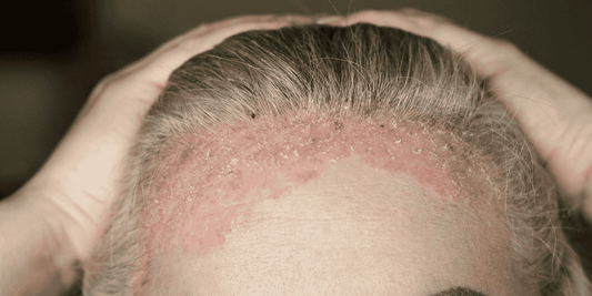 The Scalp Psoriasis Chokehold: Why Your Follicles Are Struggling