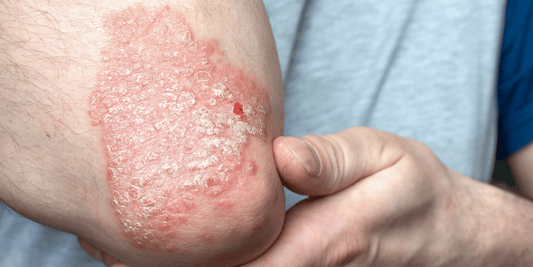 Beyond "Steroid Trap": Why Your Psoriasis Rebounds & How to Fix Your Gut