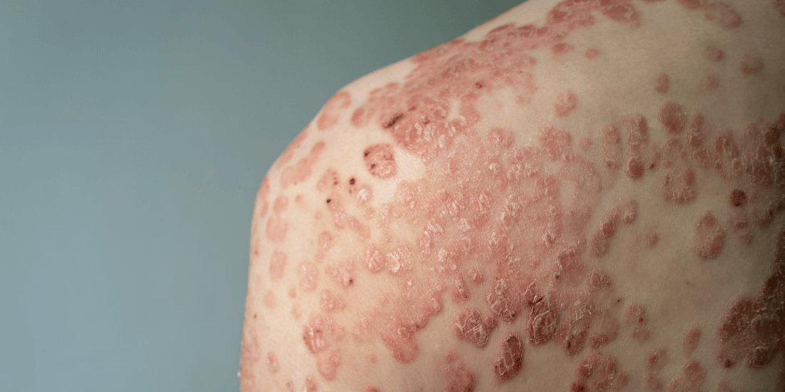 Beyond the Quick Fix: How to Break the Psoriasis "Steroid Cycle" Safely