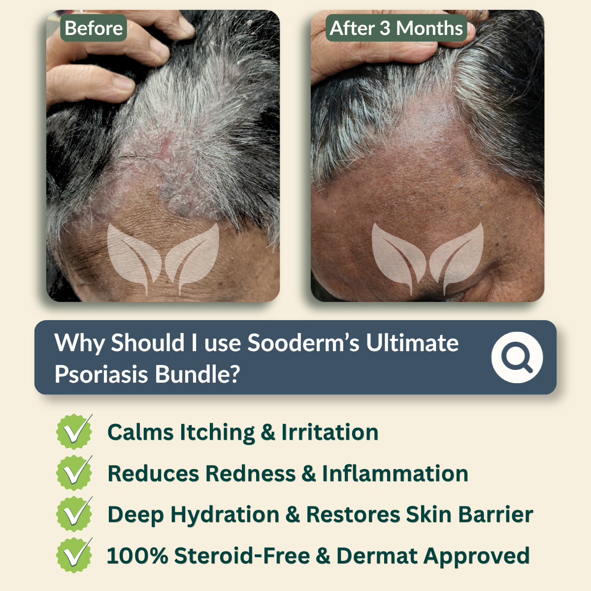 Ultimate Psoriasis Relief Bundle
